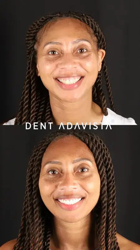 yüz öncesi sonrası