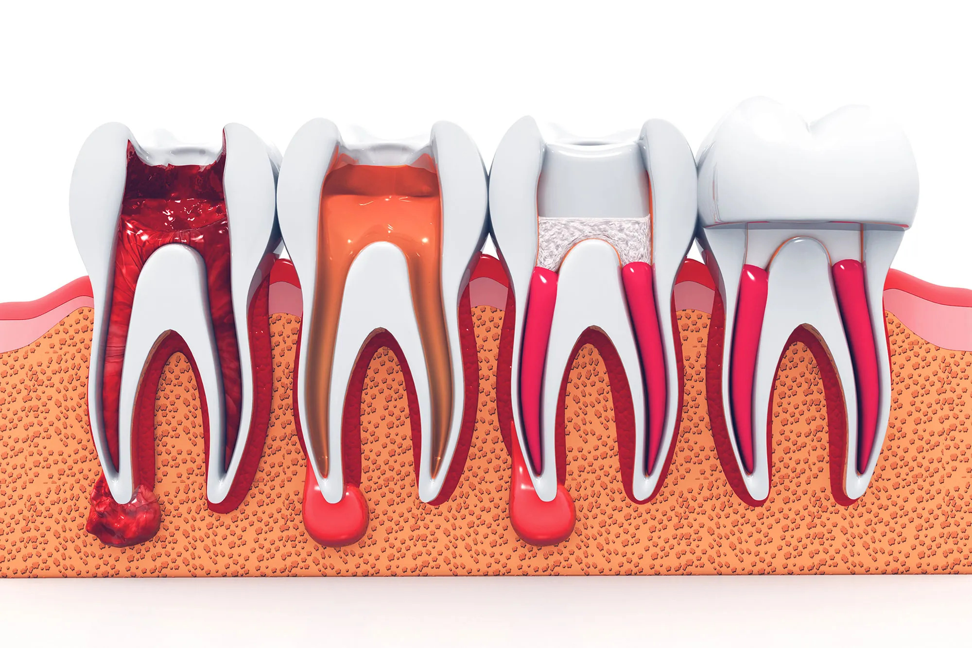 root canal treatment